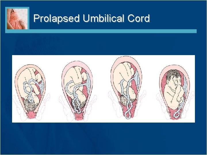 Prolapsed Umbilical Cord 
