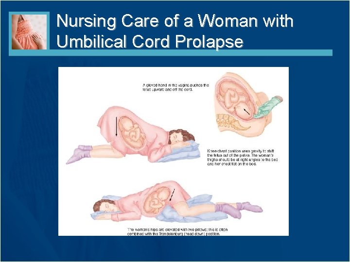 Nursing Care of a Woman with Umbilical Cord Prolapse 