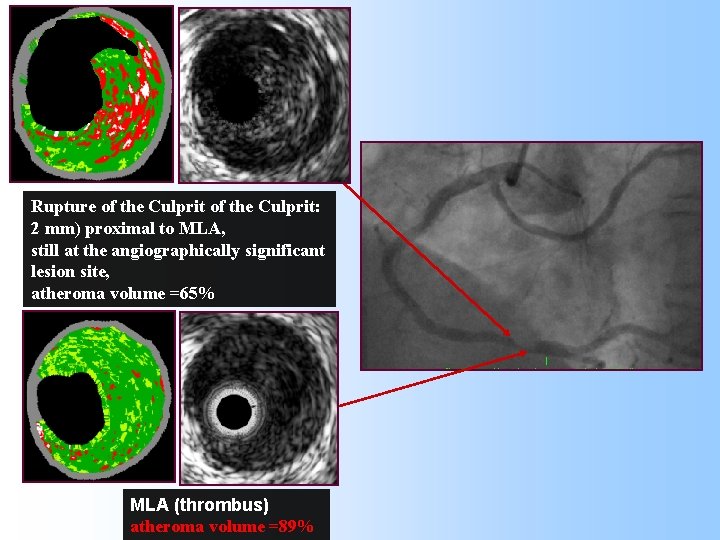 VH IVUS Rupture of the Culprit: 2 mm) proximal to MLA, still at the