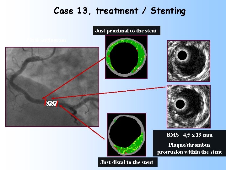 Case 13, treatment / Stenting Just proximal to the stent Final angiogram BMS 4,