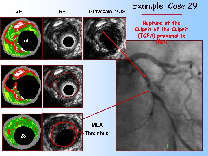 VH RF Grayscale IVUS Rupture of the Culprit (TCFA) proximal to MLA 55 MLA