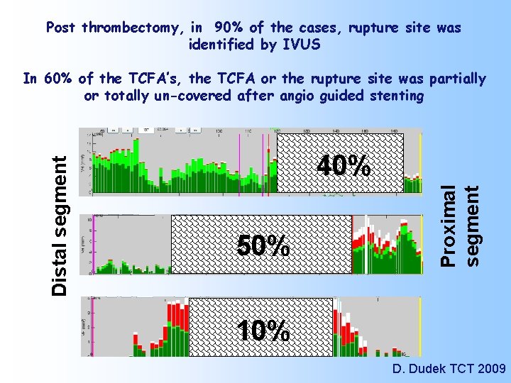 Post thrombectomy, in 90% of the cases, rupture site was identified by IVUS 40%