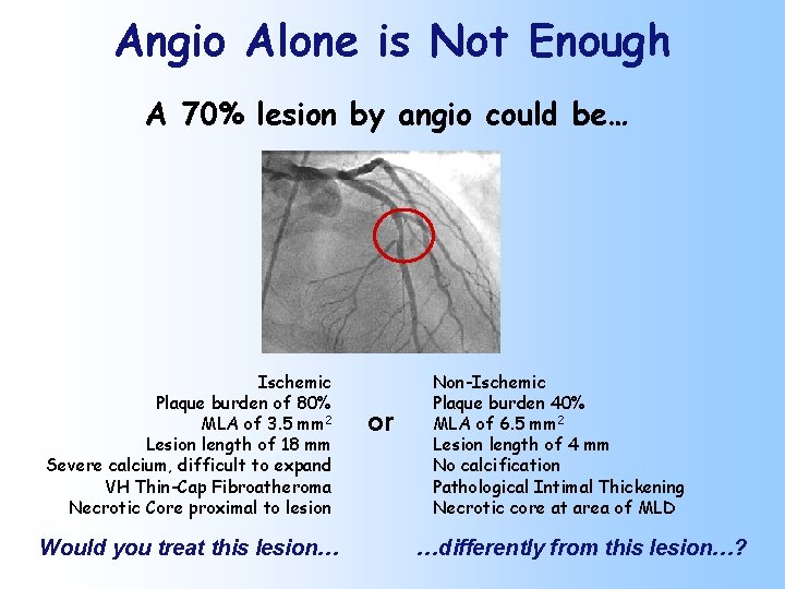 Angio Alone is Not Enough A 70% lesion by angio could be… Ischemic Plaque