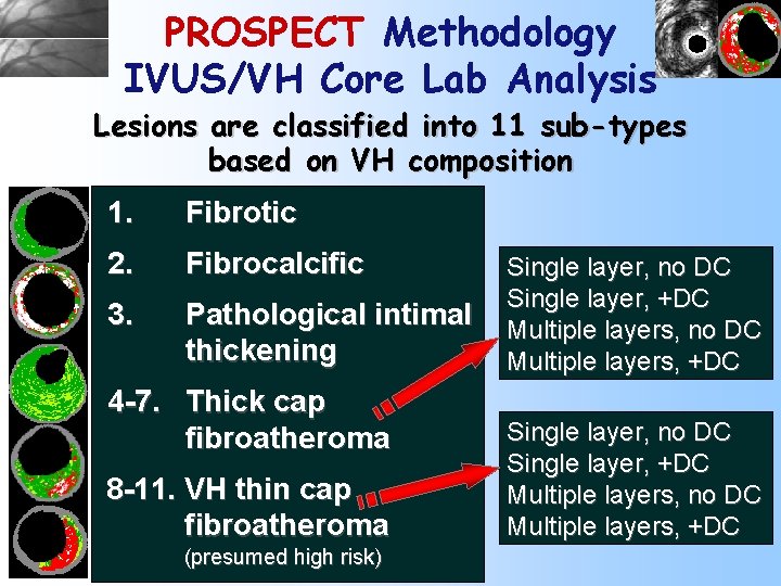 PROSPECT Methodology IVUS/VH Core Lab Analysis Lesions are classified into 11 sub-types based on