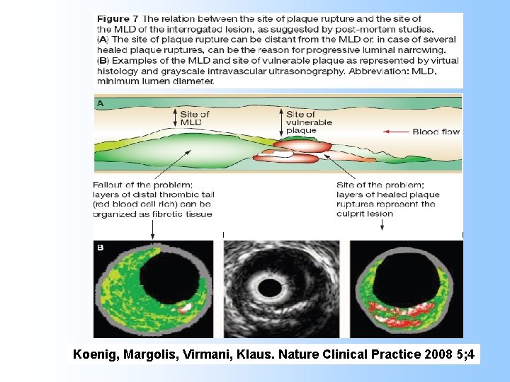 Koenig, Margolis, Virmani, Klaus. Nature Clinical Practice 2008 5; 4 