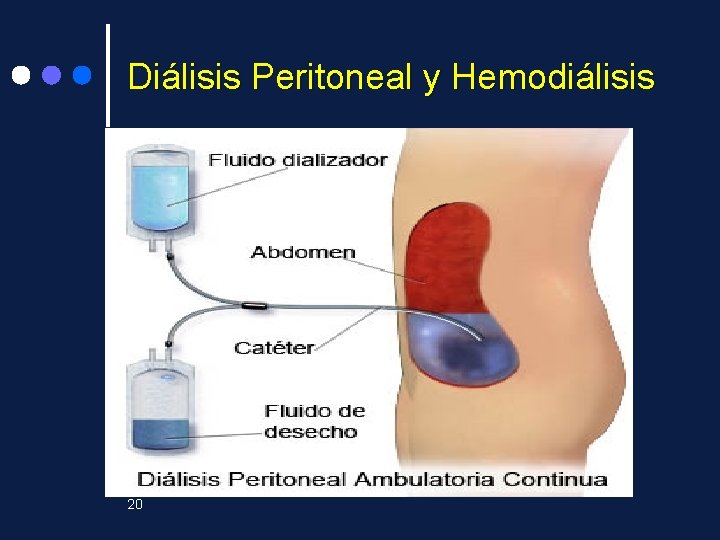 Diálisis Peritoneal y Hemodiálisis 20 