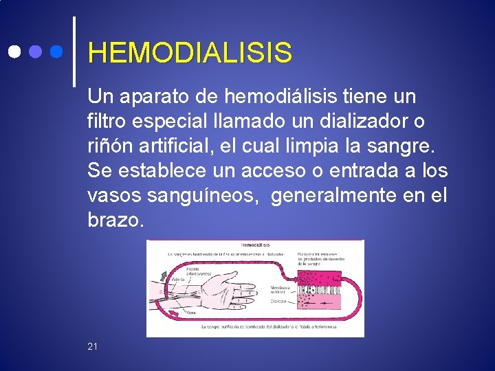 HEMODIALISIS Un aparato de hemodiálisis tiene un filtro especial llamado un dializador o riñón