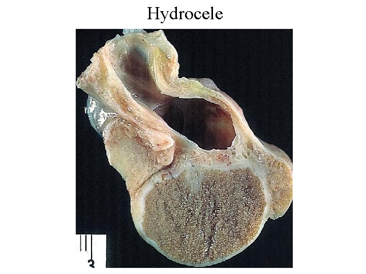 Hydrocele 