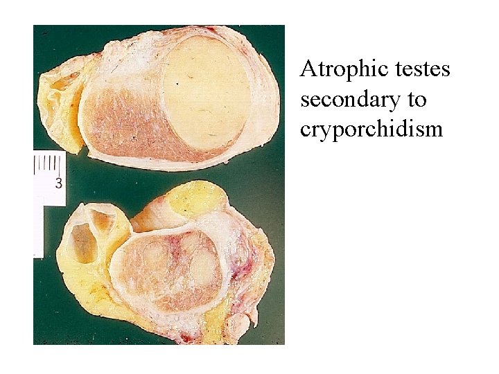 Atrophic testes secondary to cryporchidism 