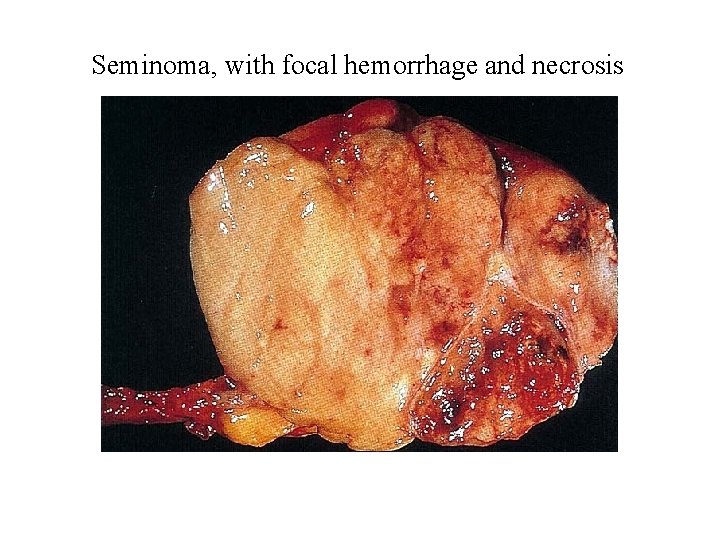 Seminoma, with focal hemorrhage and necrosis 