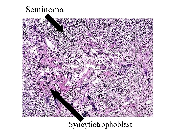 Seminoma Syncytiotrophoblast 