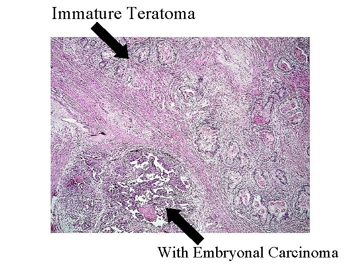 Immature Teratoma With Embryonal Carcinoma 