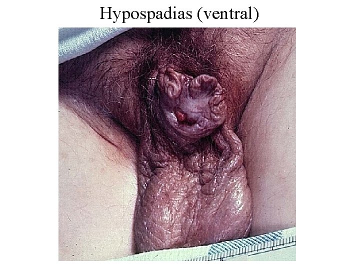 Hypospadias (ventral) 