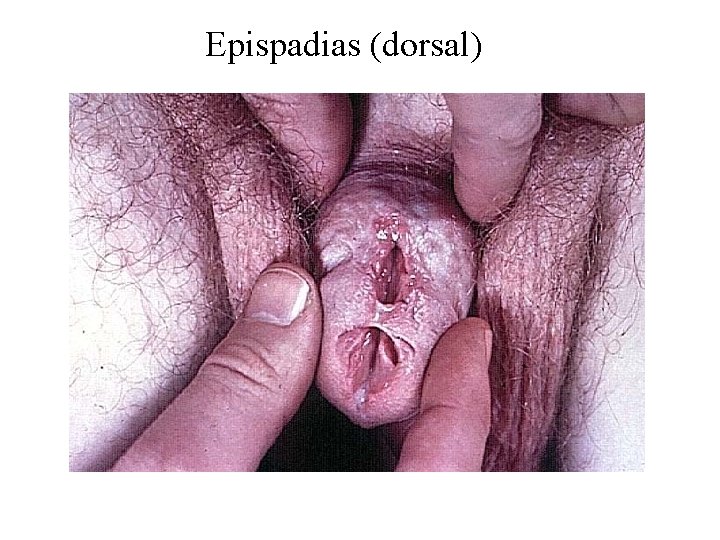 Epispadias (dorsal) 