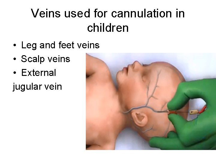 Veins used for cannulation in children • Leg and feet veins • Scalp veins