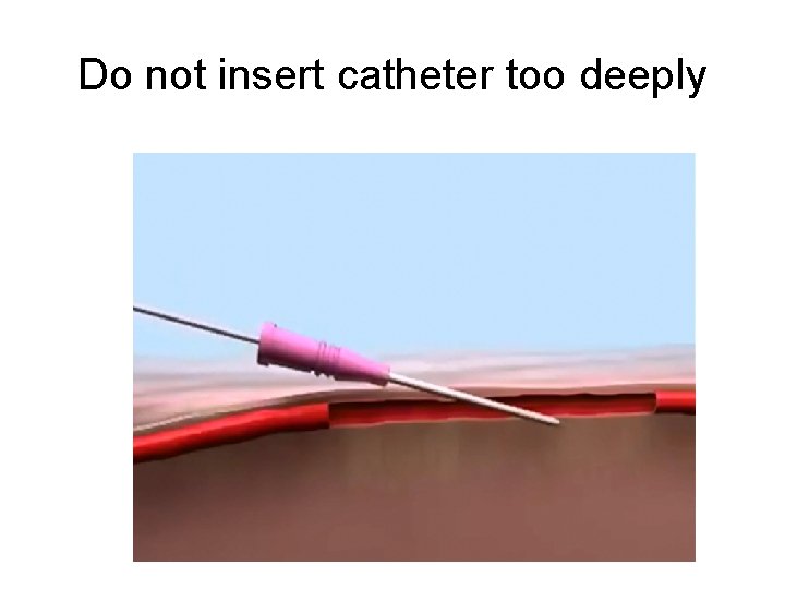 Do not insert catheter too deeply 