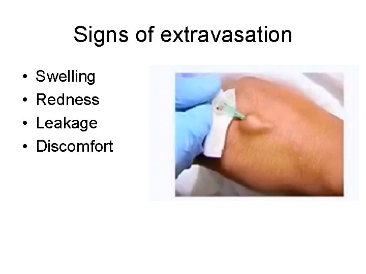 Signs of extravasation • • Swelling Redness Leakage Discomfort 