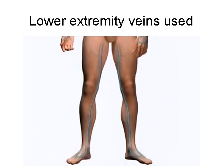 Lower extremity veins used 