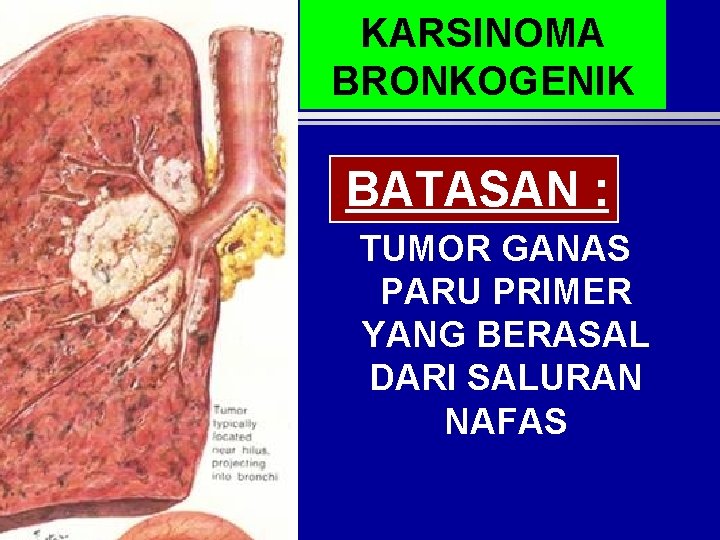 KARSINOMA BRONKOGENIK BATASAN : TUMOR GANAS PARU PRIMER YANG BERASAL DARI SALURAN NAFAS KARSINOMA BRONKOGENIK BATASAN : TUMOR GANAS PARU PRIMER YANG BERASAL DARI SALURAN NAFAS