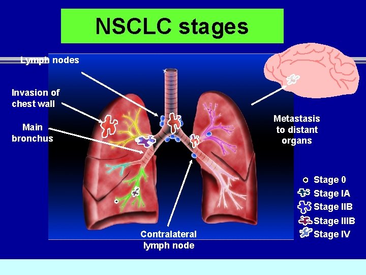 NSCLC stages Lymph nodes Invasion of chest wall Metastasis to distant organs Main bronchus