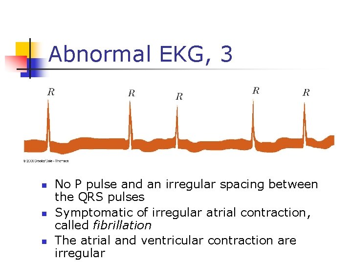 Abnormal EKG, 3 n n n No P pulse and an irregular spacing between