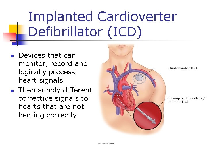 Implanted Cardioverter Defibrillator (ICD) n n Devices that can monitor, record and logically process