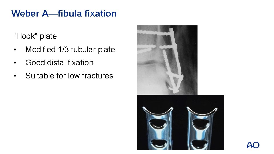 Weber A—fibula fixation “Hook” plate • Modified 1/3 tubular plate • Good distal fixation