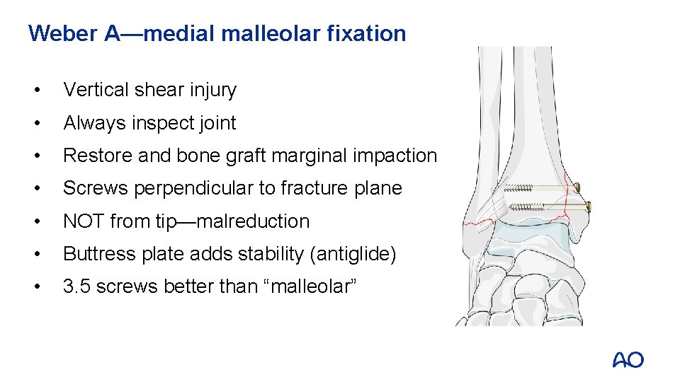 Weber A—medial malleolar fixation • Vertical shear injury • Always inspect joint • Restore