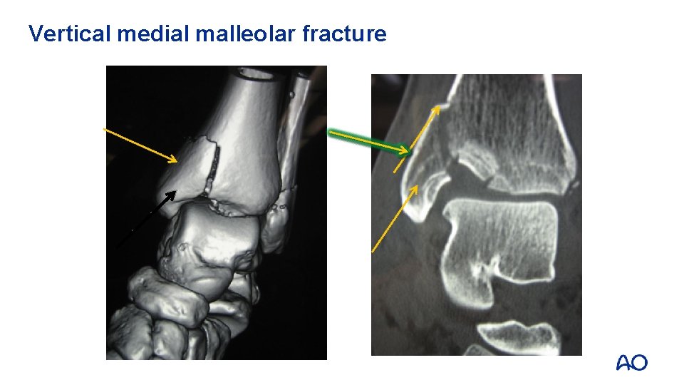 Vertical medial malleolar fracture 