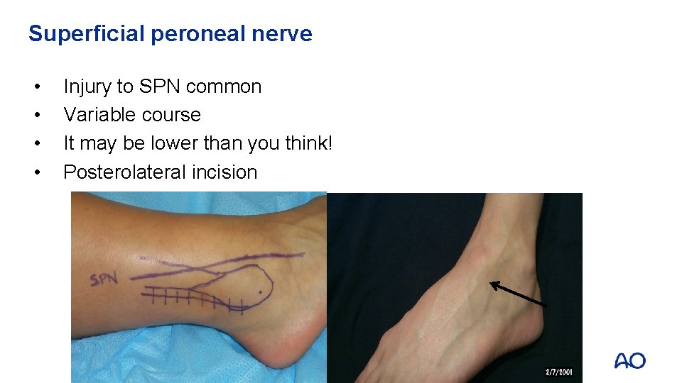 Superficial peroneal nerve • • Injury to SPN common Variable course It may be