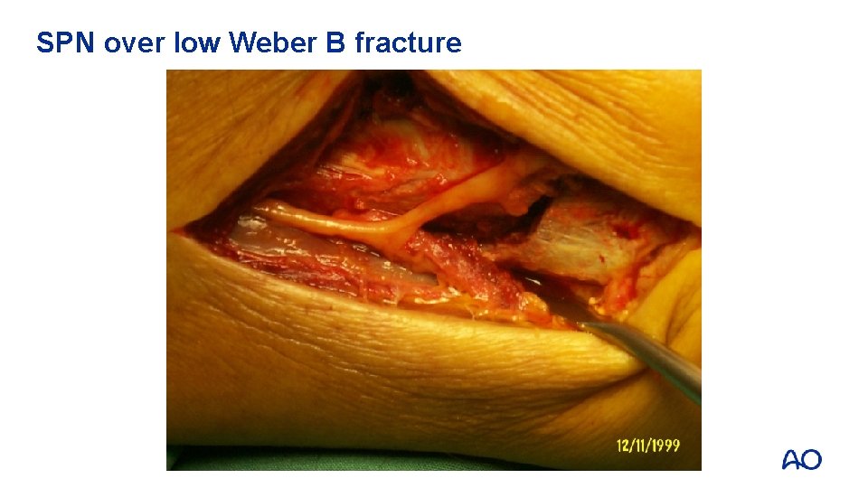 SPN over low Weber B fracture 