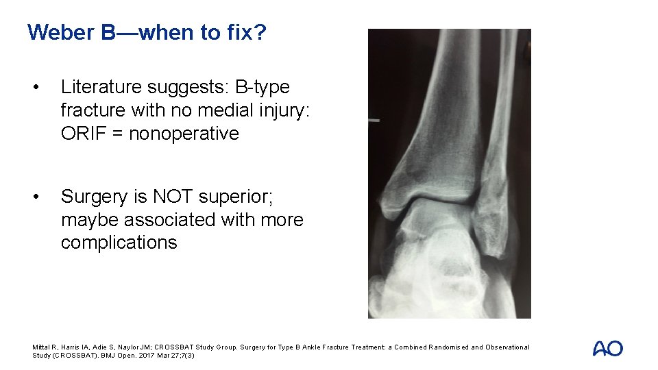 Weber B—when to fix? • Literature suggests: B-type fracture with no medial injury: ORIF