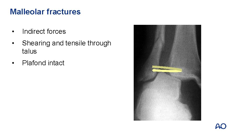 Malleolar fractures • Indirect forces • Shearing and tensile through talus • Plafond intact