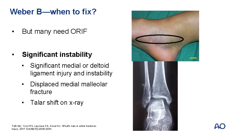 Weber B—when to fix? • But many need ORIF • Significant instability • Significant