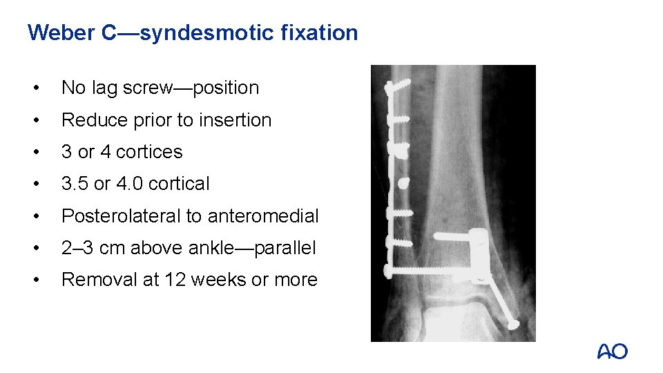 Weber C—syndesmotic fixation • No lag screw—position • Reduce prior to insertion • 3