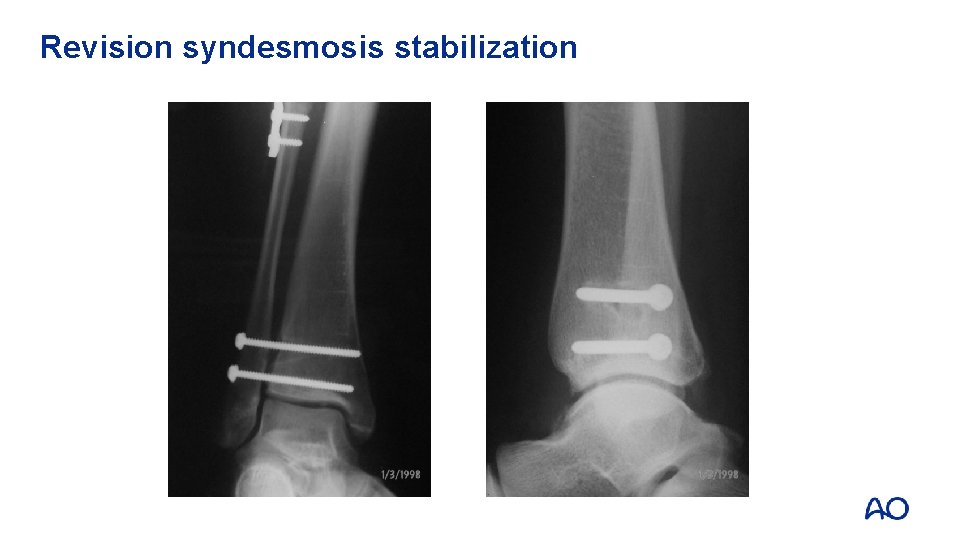 Revision syndesmosis stabilization 