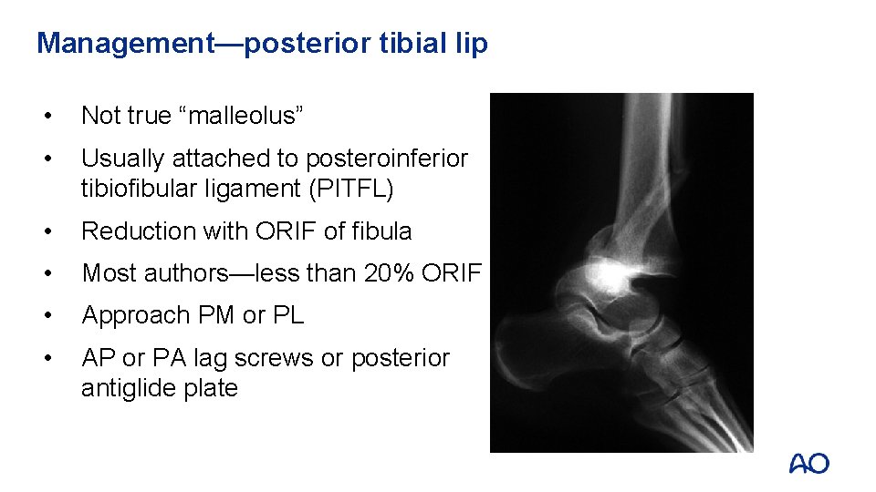 Management—posterior tibial lip • Not true “malleolus” • Usually attached to posteroinferior tibiofibular ligament