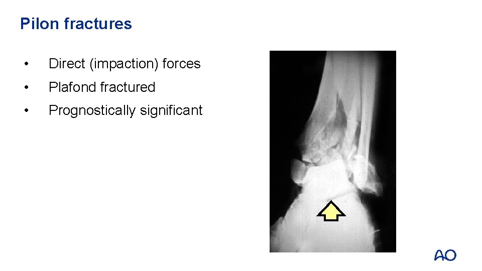 Pilon fractures • Direct (impaction) forces • Plafond fractured • Prognostically significant 