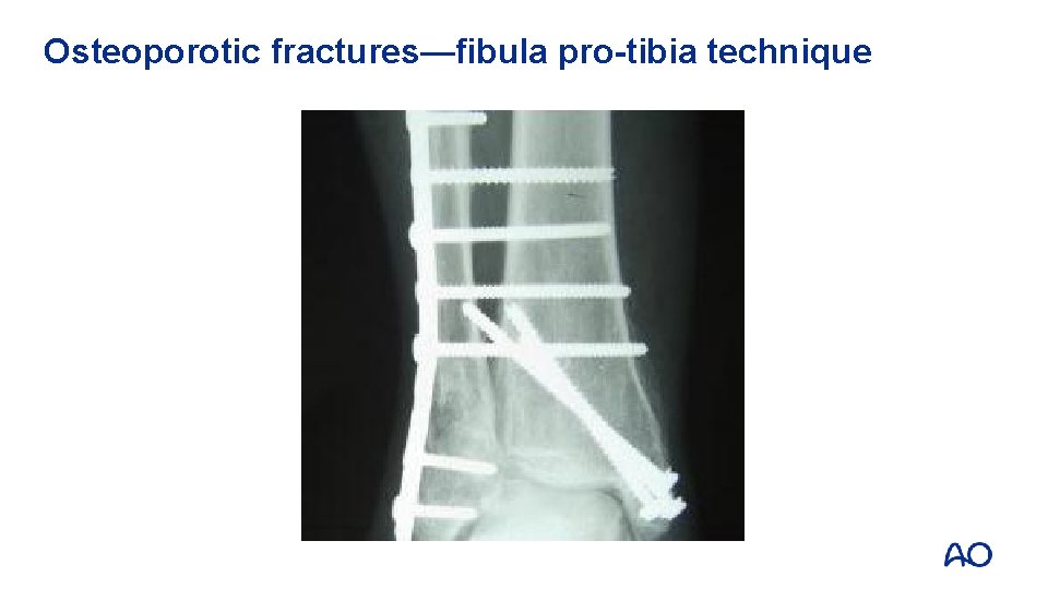 Osteoporotic fractures—fibula pro-tibia technique 