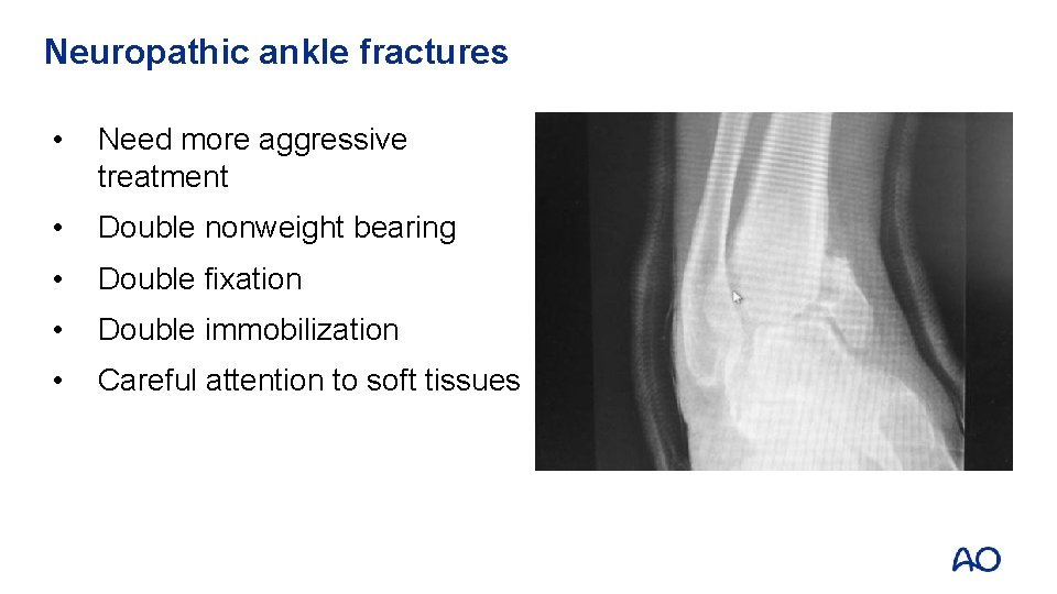 Neuropathic ankle fractures • Need more aggressive treatment • Double nonweight bearing • Double