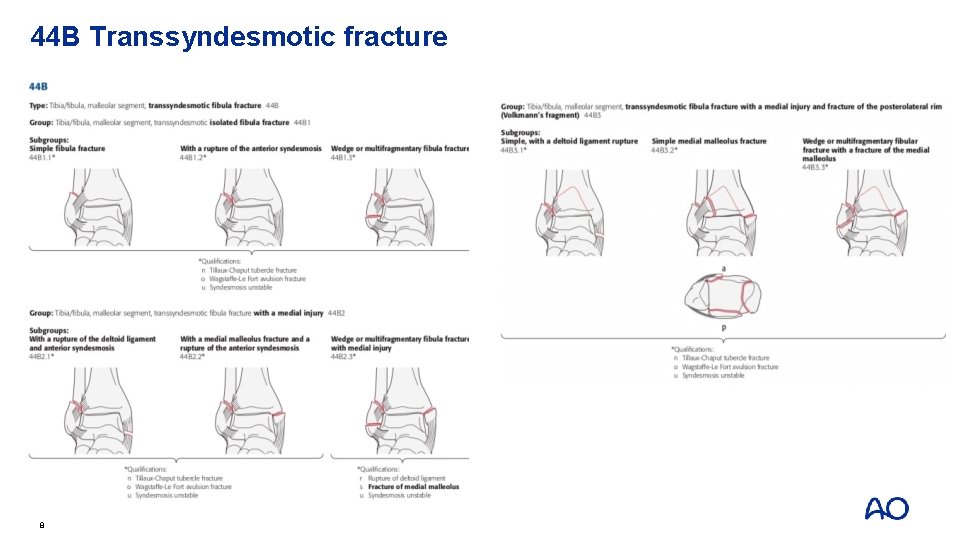 44 B Transsyndesmotic fracture 8 
