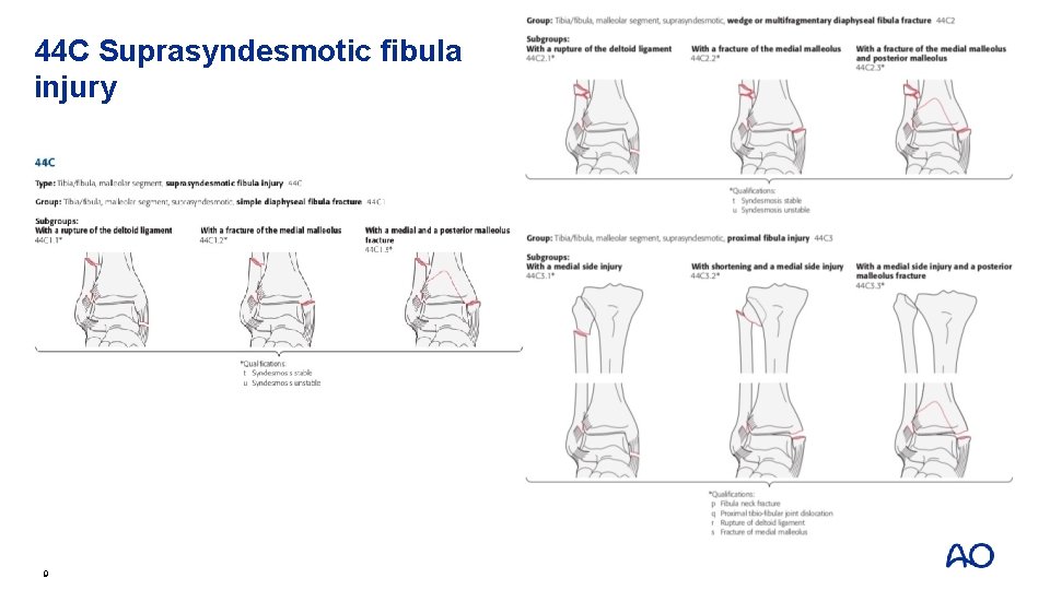 44 C Suprasyndesmotic fibula injury 9 