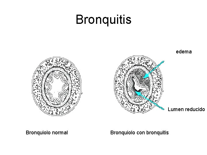 Bronquitis edema Lumen reducido Bronquiolo normal Bronquiolo con bronquitis Bronquitis edema Lumen reducido Bronquiolo normal Bronquiolo con bronquitis