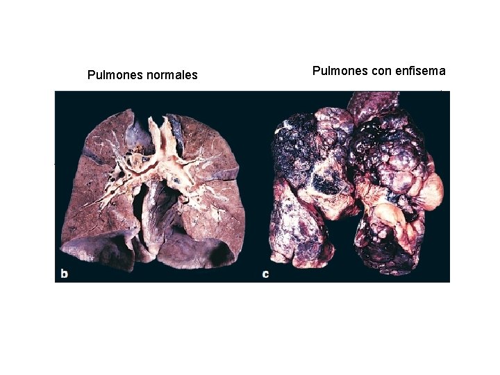Pulmones normales Pulmones con enfisema Pulmones normales Pulmones con enfisema