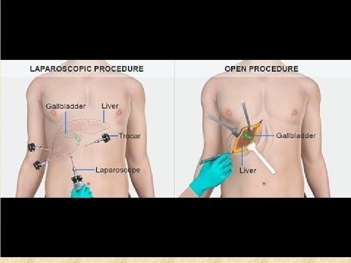 gallstones 11 