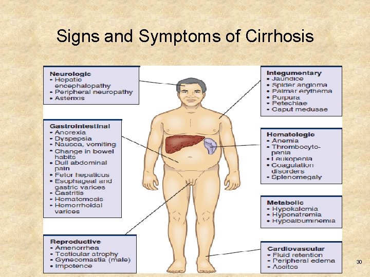 Signs and Symptoms of Cirrhosis Copyright © 2017, Elsevier Inc. All rights reserved. 30