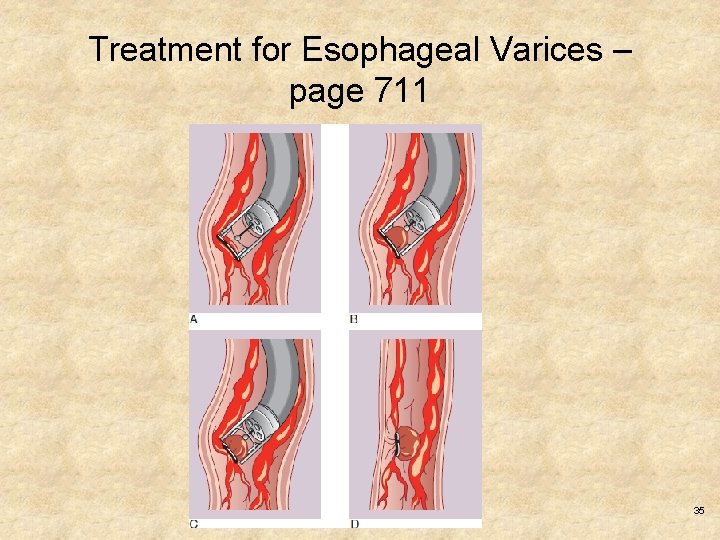 Treatment for Esophageal Varices – page 711 Copyright © 2017, Elsevier Inc. All rights