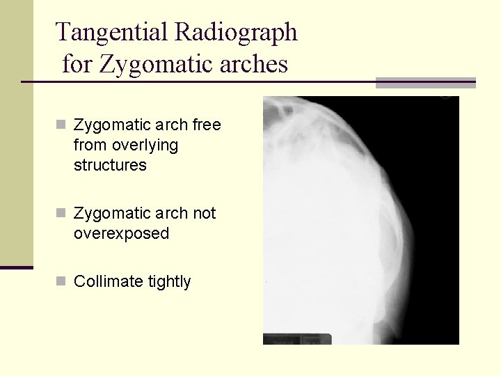 Tangential Radiograph for Zygomatic arches n Zygomatic arch free from overlying structures n Zygomatic