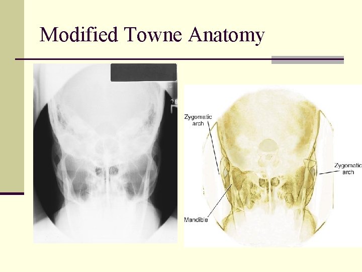 Modified Towne Anatomy 