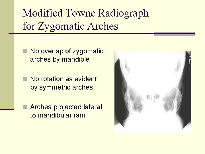 Modified Towne Radiograph for Zygomatic Arches n No overlap of zygomatic arches by mandible